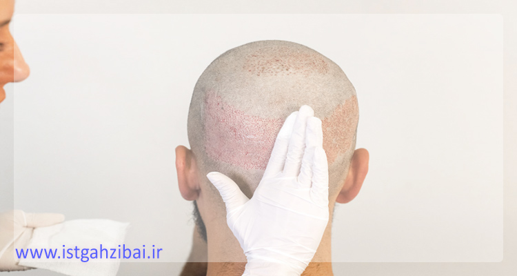 درد بعد از کاشت مو